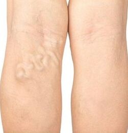 Síntomas de varices