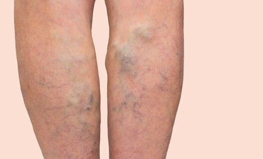 Varices