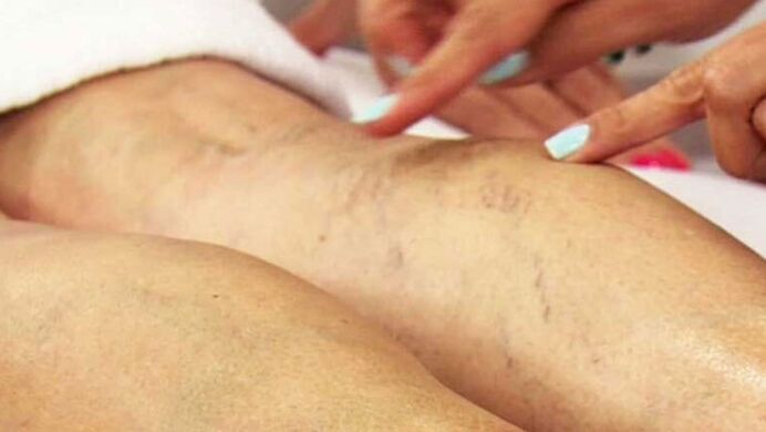 Varices das extremidades inferiores
