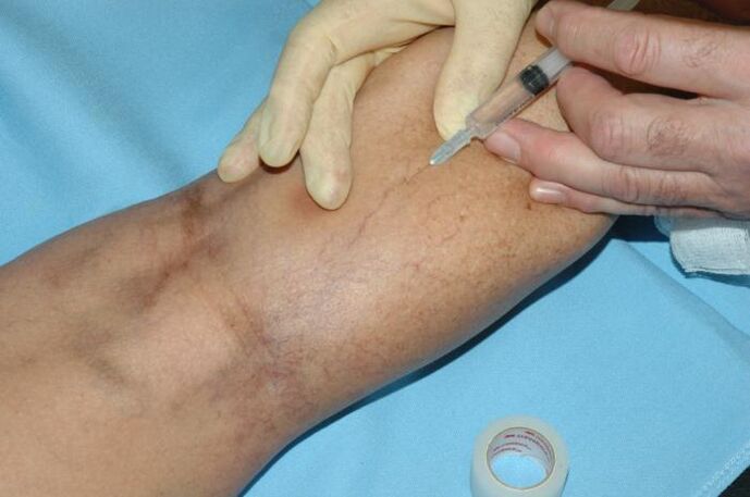 escleroterapia