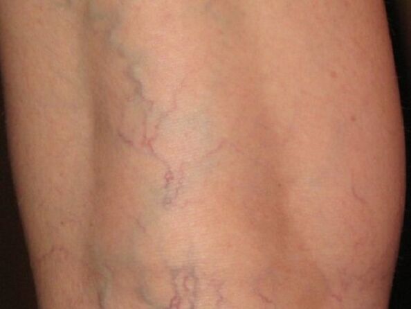 Etapas de varices