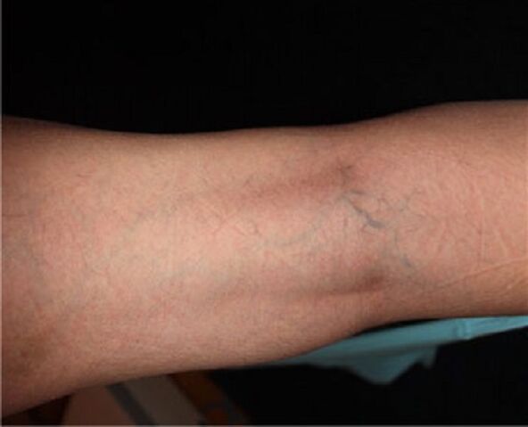 Síntomas de varices