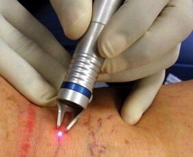 Como se realiza o tratamento con láser das varices