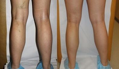 Tratamento con láser de varices fotografía antes e despois