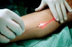 Tratamento con láser de varices nas pernas