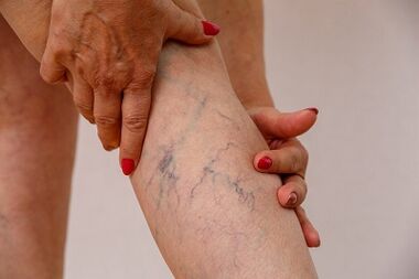 varices das extremidades inferiores