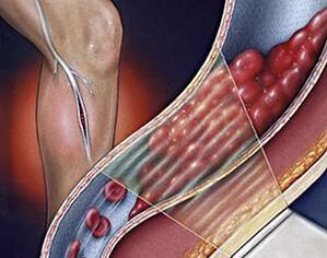 varices das veas profundas das extremidades inferiores