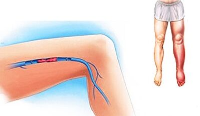 Posibles complicacións de varices