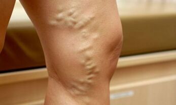 Signos e síntomas de varices nas pernas